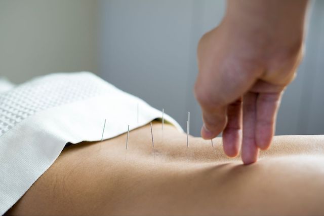 A person receiving acupuncture treatment at the Manhattan Chiropractic Center, with multiple needles inserted along their bare lower back as a practitioner's hand adjusts one of the needles.